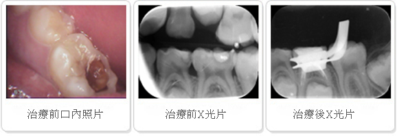 case 2 5岁小女孩左下第二乳臼齿因严重蛀牙疼痛求诊.